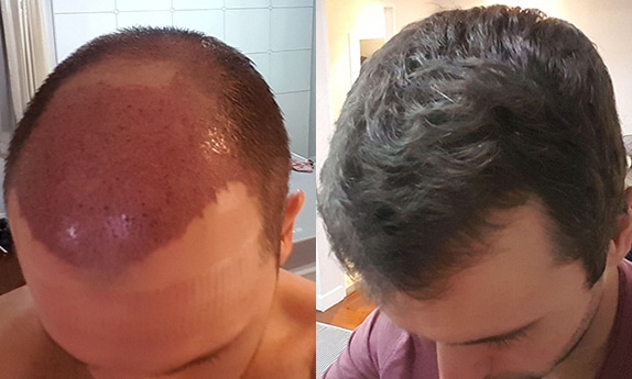 fut hair transplant