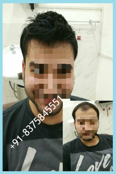 Non Surgical Hair Replacement in Delhi | Hair Replacement in Delhi
