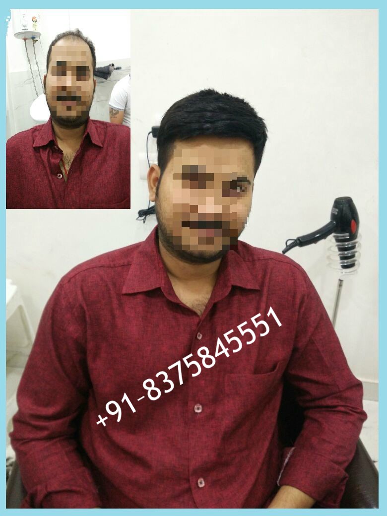 Hair Bonding in Delhi