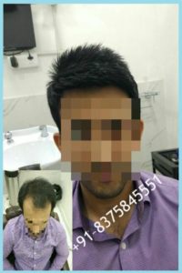 hair fixing in delhi