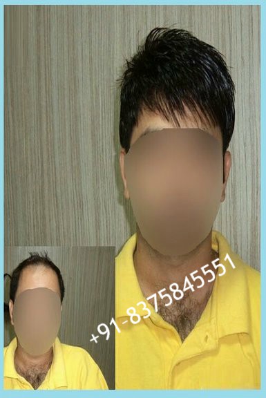 Hair Fixing cost in India | Permanent Hair Fixing | Good Hair Fixing in  Delhi
