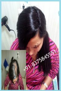 hair patch in india