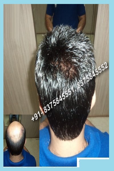 Hair Fixing cost in India | Permanent Hair Fixing | Good Hair Fixing in  Delhi