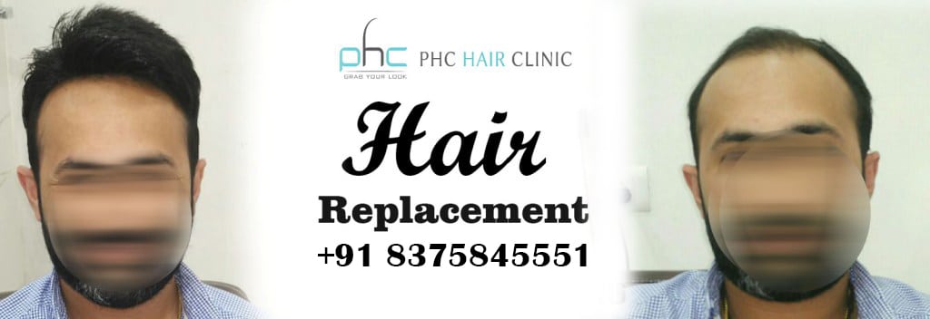 hair replacement system