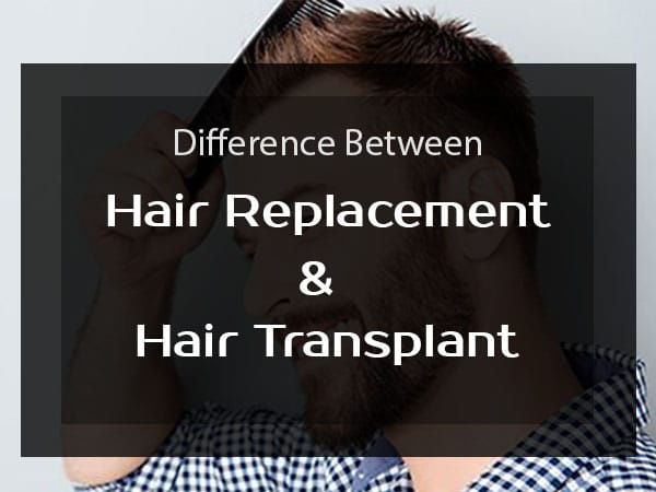hair transplant vs hair replacement