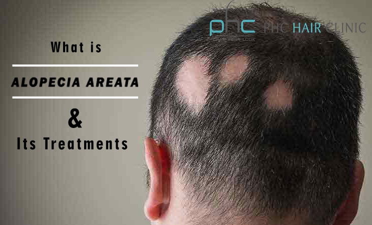 alopecia areata