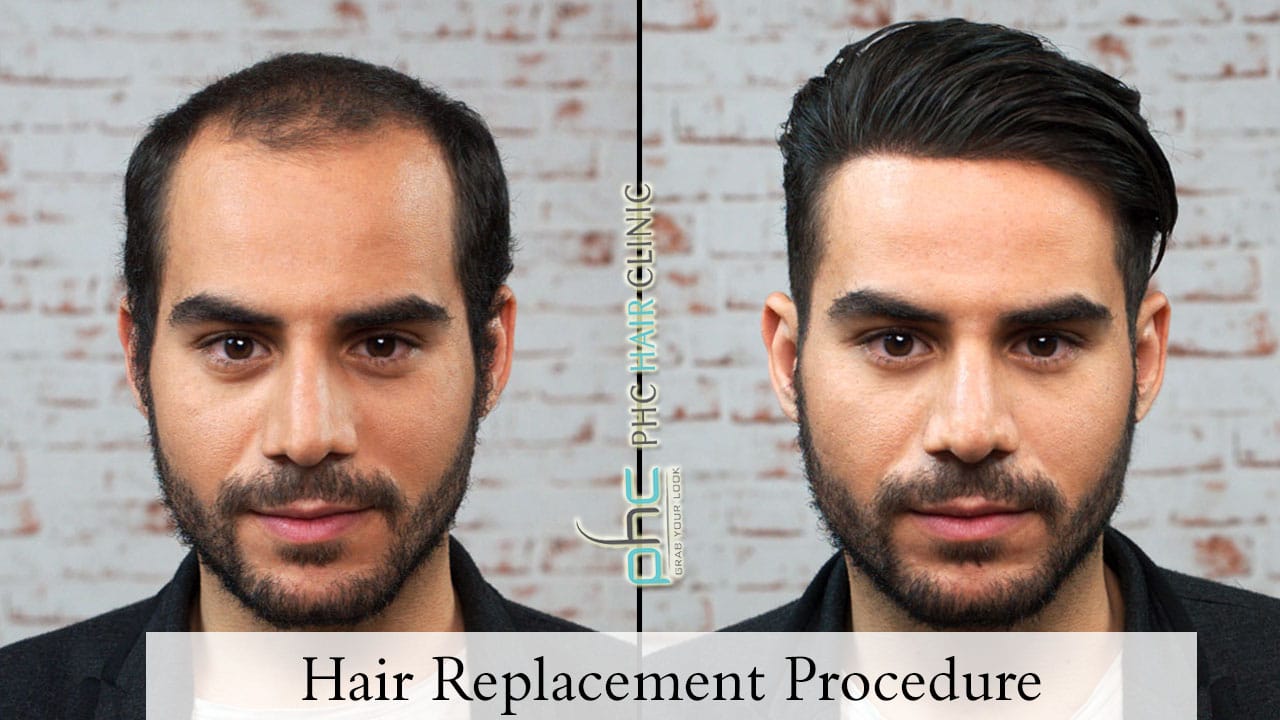 Hair Replacement Procedure To Get The Hair You Dream Off
